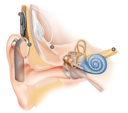 Graphic image of cochlear part of the ear.