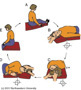 The Epley maneuver is an exercise help that helps to treat the symptoms of benign paroxysmal positional vertigo (BPPV).