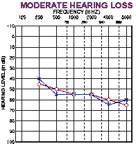 Audiogram test- moderate hearing loss.