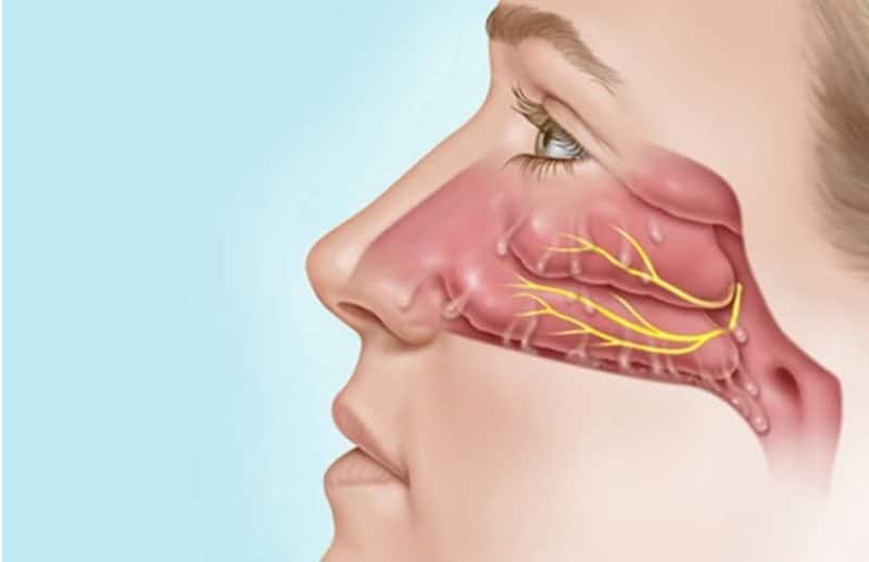 post nasal drip without runny nose