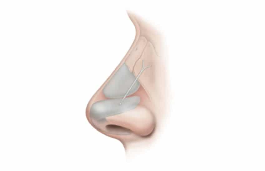 Benefits of Latera nasal implant.