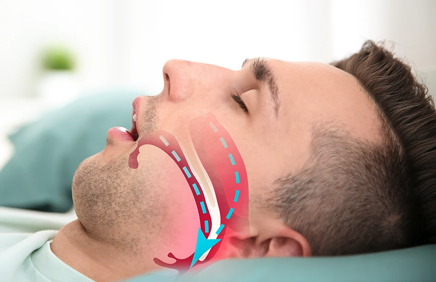 Normal Airway after Obstructive Sleep Apnea Treatment