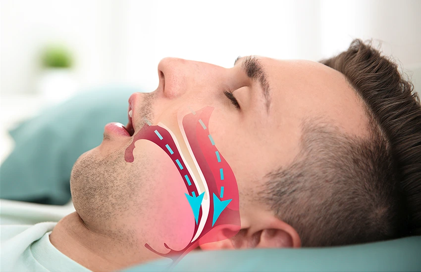 Obstructive sleep apnea is considered a serious medical condition.