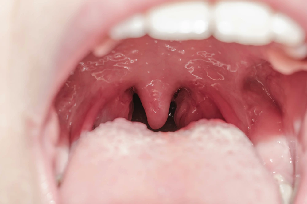A closer image of throat inside the mouth.